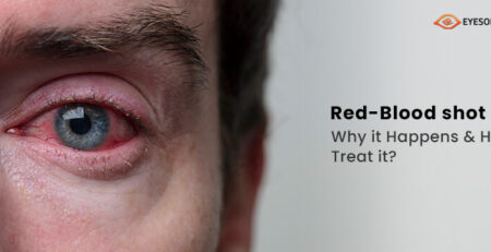 Eyes on Brickell: Red Eyes: Causes & Remedies