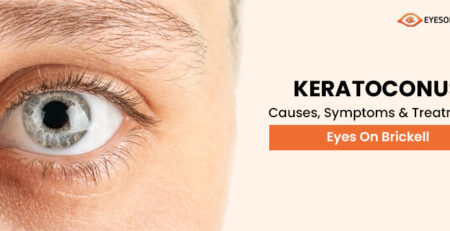 Eyes on Brickell: Keratoconus Causes, Symptoms and Treatments