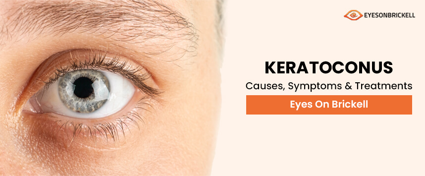 Eyes on Brickell: Keratoconus Causes, Symptoms and Treatments