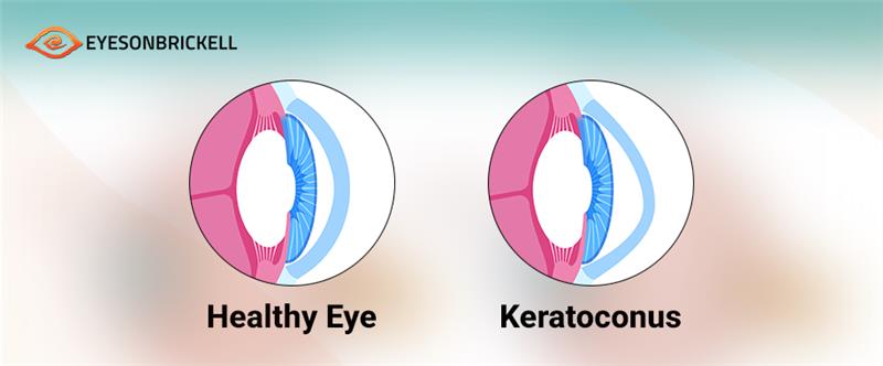 Keratoconus